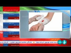محققان برای جلوگیری از خون ریزی ، نانو محصولی از جنس صدف و پیله کرم ابریشم تولید کردند.