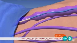 متخصصان شرکتی دانش بنیان، موفق شدند دستگاه لیزر نانومتری را با طول موج‌های مختلف برای درمان بیماری واریس بومی‌سازی کنند.