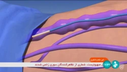 متخصصان شرکتی دانش بنیان، موفق شدند دستگاه لیزر نانومتری را با طول موج‌های مختلف برای درمان بیماری واریس بومی‌سازی کنند.